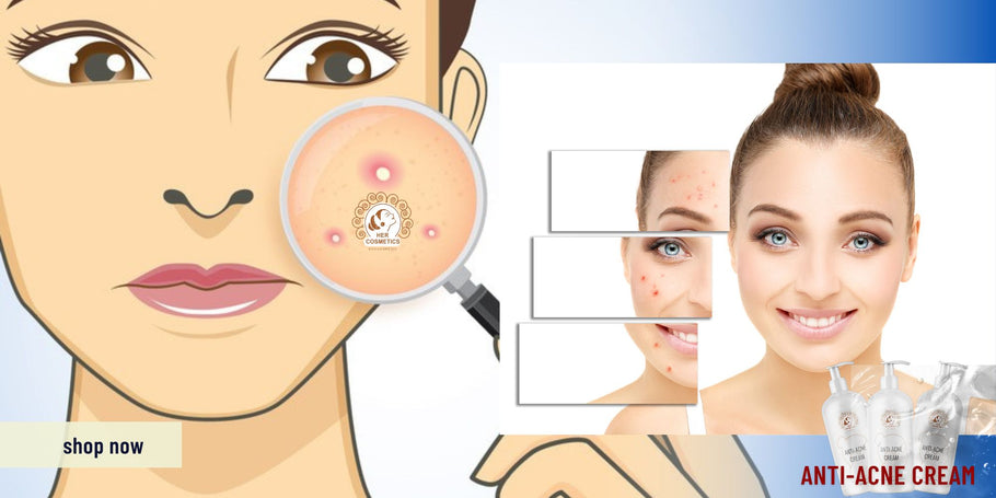 Save your skin: Tips to eliminate acne